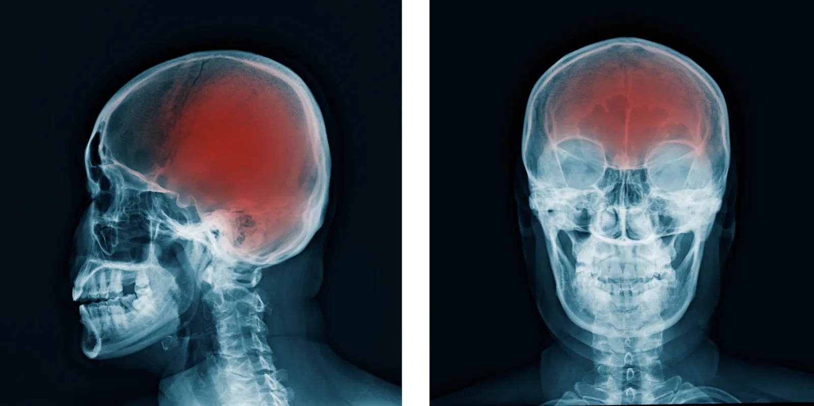 Lesión Cerebral Traumática